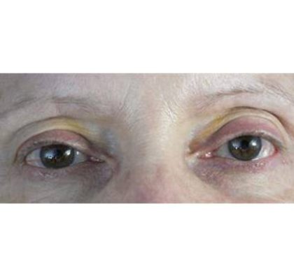 Blepharoplasty (Eyelid Surgery) Before & After Patient #441