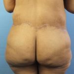 Body Contouring Before & After Patient #287