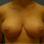 Breast Reduction Before & After Patient #1771